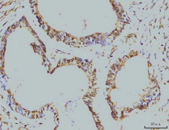 IHC staining of FFPE human colonic adenocarcinoma tissue with Replication Protein A2 antibody. HIER: boil tissue sections in pH8 EDTA for 20 min and allow to cool before testing.