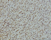 IHC staining of FFPE human stomach cancer tissue with Replication Protein A2 antibody. HIER: boil tissue sections in pH8 EDTA for 20 min and allow to cool before testing.