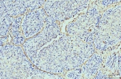 IHC staining of FFPE human lung cancer tissue with Annexin VI antibody. HIER: boil tissue sections in pH8 EDTA for 20 min and allow to cool before testing.