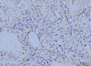 IHC staining of FFPE human renal clear cell carcinoma tissue with Annexin VI antibody. HIER: boil tissue sections in pH8 EDTA for 20 min and allow to cool before testing.