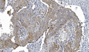 IHC staining of FFPE human lung cancer tissue with Cytochrome P450 Reductase antibody. HIER: boil tissue sections in pH8 EDTA for 20 min and allow to cool before testing.