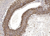 IHC staining of FFPE human liver cancer tissue with Cytochrome P450 Reductase antibody. HIER: boil tissue sections in pH8 EDTA for 20 min and allow to cool before testing.