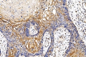 IHC staining of FFPE human esophageal squamous carcinoma tissue with Cytochrome P450 Reductase antibody. HIER: boil tissue sections in pH8 EDTA for 20 min and allow to cool before testing.