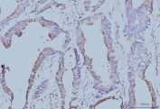 IHC staining of FFPE human colonic adenocarcinoma tissue with EIF4A1 antibody. HIER: boil tissue sections in pH8 EDTA for 20 min and allow to cool before testing.