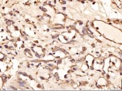 IHC staining of FFPE human kidney cancer tissue with AASS antibody. HIER: boil tissue sections in pH8 EDTA for 20 min and allow to cool before testing.