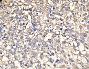 IHC staining of FFPE human liver cancer tissue with AASS antibody. HIER: boil tissue sections in pH8 EDTA for 20 min and allow to cool before testing.