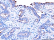 IHC staining of FFPE human bladder adenosquamous carcinoma tissue with ADAM9 antibody. HIER: boil tissue sections in pH8 EDTA for 20 min and allow to cool before testing.