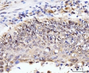 IHC staining of FFPE human lung cancer tissue with AKAP 95 antibody. HIER: boil tissue sections in pH8 EDTA for 20 min and allow to cool before testing.