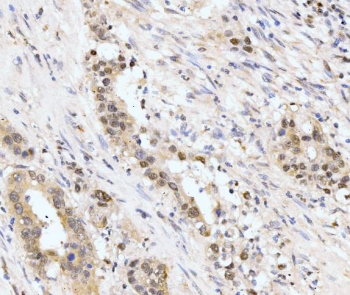 IHC staining of FFPE human appendiceal adenocarcinoma tissue with AKAP 95 antibody. HIER: boil tissue sections in pH8 EDTA for 20 min and allow to cool before testing.
