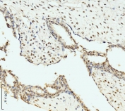 IHC staining of FFPE human breast cancer tissue with AKAP 95 antibody. HIER: boil tissue sections in pH8 EDTA for 20 min and allow to cool before testing.