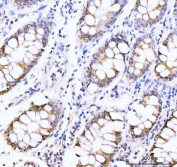 IHC staining of FFPE human gastric adenocarcinoma tissue with AKAP 95 antibody. HIER: boil tissue sections in pH8 EDTA for 20 min and allow to cool before testing.
