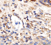 IHC staining of FFPE human liver cancer tissue with AP2A2 antibody. HIER: boil tissue sections in pH8 EDTA for 20 min and allow to cool before testing.