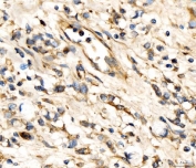IHC staining of FFPE human stomach cancer tissue with AP2A2 antibody. HIER: boil tissue sections in pH8 EDTA for 20 min and allow to cool before testing.