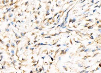 IHC staining of FFPE human breast cancer tissue with AP2A2 antibody. HIER: boil tissue sections in pH8 EDTA for 20 min and allow to cool before testing.