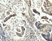 IHC staining of FFPE human gastric adenocarcinoma tissue with BCKDK antibody. HIER: boil tissue sections in pH8 EDTA for 20 min and allow to cool before testing.