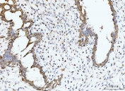 IHC staining of FFPE human breast cancer tissue with BCKDK antibody. HIER: boil tissue sections in pH8 EDTA for 20 min and allow to cool before testing.