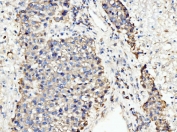 IHC staining of FFPE human liver cancer tissue with BCKDK antibody. HIER: boil tissue sections in pH8 EDTA for 20 min and allow to cool before testing.