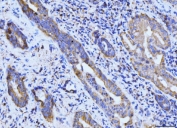 IHC staining of FFPE human gall bladder adenosquamous carcinoma tissue with BCKDK antibody. HIER: boil tissue sections in pH8 EDTA for 20 min and allow to cool before testing.