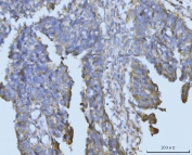 IHC staining of FFPE human colonic adenocarcinoma tissue with BCKDK antibody. HIER: boil tissue sections in pH8 EDTA for 20 min and allow to cool before testing.
