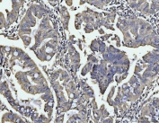 IHC staining of FFPE human gastric adenocarcinoma tissue with BIN1 antibody. HIER: boil tissue sections in pH8 EDTA for 20 min and allow to cool before testing.