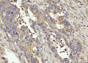 IHC staining of FFPE human appendiceal adenocarcinoma tissue with BIN1 antibody. HIER: boil tissue sections in pH8 EDTA for 20 min and allow to cool before testing.