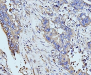 IHC staining of FFPE human appendiceal adenocarcinoma tissue with BZW2 antibody. HIER: boil tissue sections in pH8 EDTA for 20 min and allow to cool before testing.