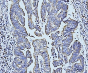 IHC staining of FFPE human gastric adenocarcinoma tissue with BZW2 antibody. HIER: boil tissue sections in pH8 EDTA for 20 min and allow to cool before testing.