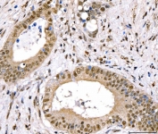 IHC staining of FFPE human gallbladder carcinoma tissue with CRTC3 antibody. HIER: boil tissue sections in pH8 EDTA for 20 min and allow to cool before testing.