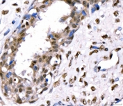 IHC staining of FFPE human breast cancer tissue with CRTC3 antibody. HIER: boil tissue sections in pH8 EDTA for 20 min and allow to cool before testing.