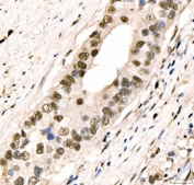 IHC staining of FFPE human colonic adenocarcinoma tissue with CRTC3 antibody. HIER: boil tissue sections in pH8 EDTA for 20 min and allow to cool before testing.