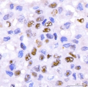 IHC staining of FFPE human liver cancer tissue with CRTC3 antibody. HIER: boil tissue sections in pH8 EDTA for 20 min and allow to cool before testing.