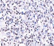 IHC staining of FFPE human lymphoma tissue with CRTC3 antibody. HIER: boil tissue sections in pH8 EDTA for 20 min and allow to cool before testing.