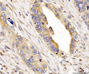 IHC staining of FFPE human colorectal cancer tissue with CYB5B antibody. HIER: boil tissue sections in pH8 EDTA for 20 min and allow to cool before testing.