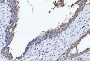 IHC staining of FFPE human breast cancer tissue with CYB5B antibody. HIER: boil tissue sections in pH8 EDTA for 20 min and allow to cool before testing.