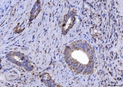IHC staining of FFPE human gall bladder adenosquamous carcinoma tissue with CYB5B antibody. HIER: boil tissue sections in pH8 EDTA for 20 min and allow to cool before testing.