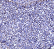 IHC staining of FFPE human lung cancer tissue with CYB5B antibody. HIER: boil tissue sections in pH8 EDTA for 20 min and allow to cool before testing.