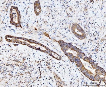 IHC staining of FFPE human bladder adenosquamous carcinoma tissue with ECSIT antibody. HIER: boil tissue sections in pH8 EDTA for 20 min and allow to cool before testing.