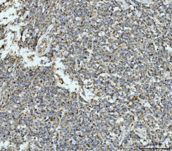 IHC staining of FFPE human lymphadenoma tissue with ECSIT antibody. HIER: boil tissue sections in pH8 EDTA for 20 min and allow to cool before testing.