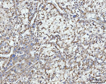 IHC staining of FFPE human liver cancer tissue with ECSIT antibody. HIER: boil tissue sections in pH8 EDTA for 20 min and allow to cool before testing.