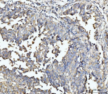IHC staining of FFPE human colonic adenocarcinoma tissue with ECSIT antibody. HIER: boil tissue sections in pH8 EDTA for 20 min and allow to cool before testing.