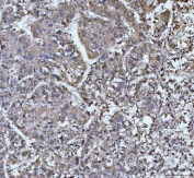 IHC staining of FFPE human liver cancer tissue with EDEM3 antibody. HIER: boil tissue sections in pH8 EDTA for 20 min and allow to cool before testing.