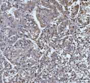 IHC staining of FFPE human liver cancer tissue with EDEM3 antibody. HIER: boil tissue sections in pH8 EDTA for 20 min and allow to cool before testing.