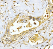 IHC staining of FFPE human appendiceal adenocarcinoma tissue with EIF3E antibody. HIER: boil tissue sections in pH8 EDTA for 20 min and allow to cool before testing.