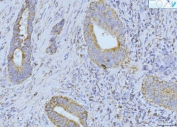 IHC staining of FFPE human bladder adenosquamous carcinoma tissue with ETFA antibody. HIER: boil tissue sections in pH8 EDTA for 20 min and allow to cool before testing.