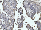 IHC staining of FFPE human colonic adenocarcinoma tissue with RRP4 antibody. HIER: boil tissue sections in pH8 EDTA for 20 min and allow to cool before testing.