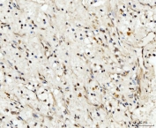 IHC staining of FFPE human renal clear cell carcinoma tissue with RRP4 antibody. HIER: boil tissue sections in pH8 EDTA for 20 min and allow to cool before testing.
