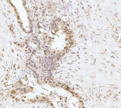 IHC staining of FFPE human appendiceal adenocarcinoma tissue with RRP4 antibody. HIER: boil tissue sections in pH8 EDTA for 20 min and allow to cool before testing.