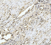 IHC staining of FFPE human appendiceal adenocarcinoma tissue with EXOSC8 antibody. HIER: boil tissue sections in pH8 EDTA for 20 min and allow to cool before testing.
