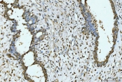 IHC staining of FFPE human breast cancer tissue with EXOSC8 antibody. HIER: boil tissue sections in pH8 EDTA for 20 min and allow to cool before testing.