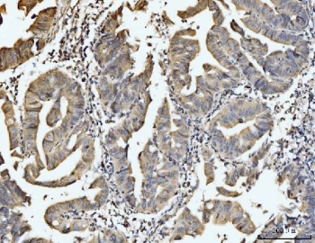 IHC staining of FFPE human gastric adenocarcinoma tissue with EXOSC8 antibody. HIER: boil tissue sections in pH8 EDTA for 20 min and allow to cool before testing.
